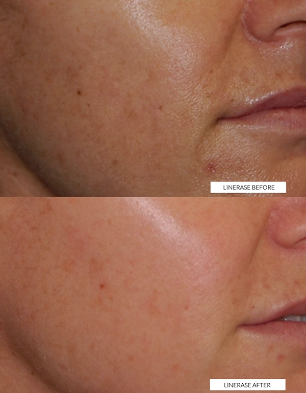 collagen treatment face hertfordshire