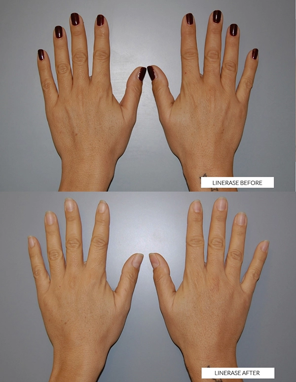 linerase hand treatment collagen hertfordshire