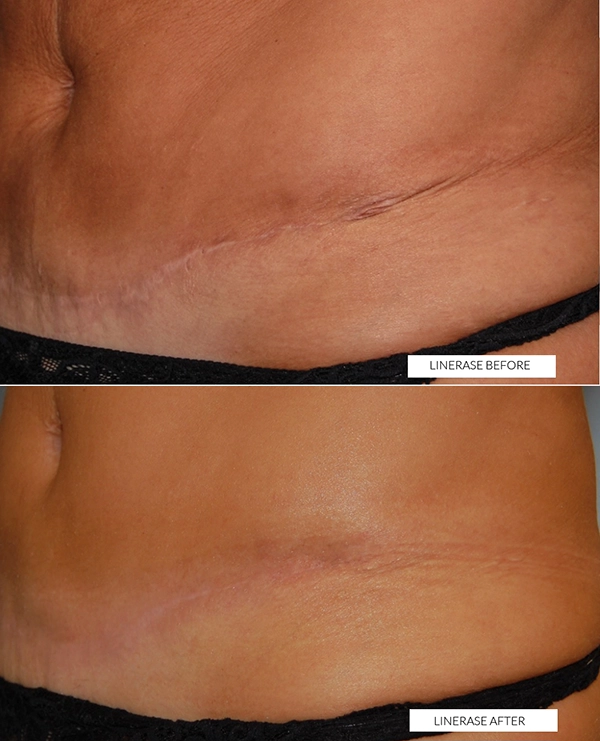 linerase scar treatment hertfordshire