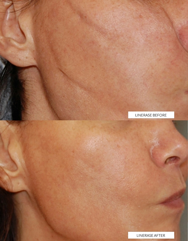 linerase treatment scar reduction hertfordshire