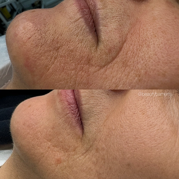 why dermal filler swells hertfordshire