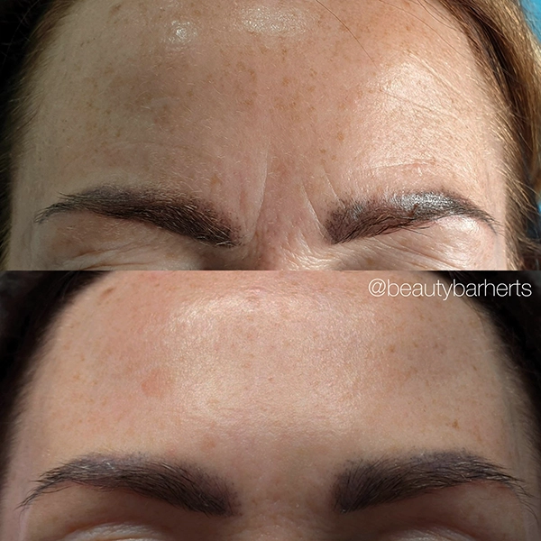 botox or fillers hertfordshire