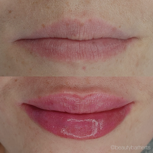 lip filler hertfordshire