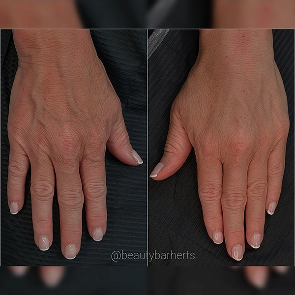 anti aging hand treatment hertfordzshire