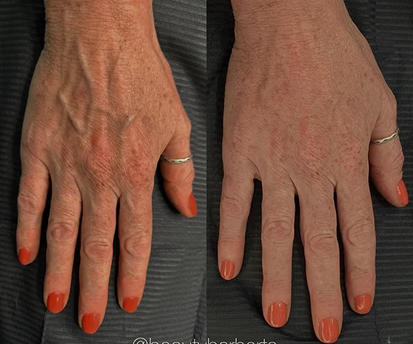 hand treatments antiage hertfordshire