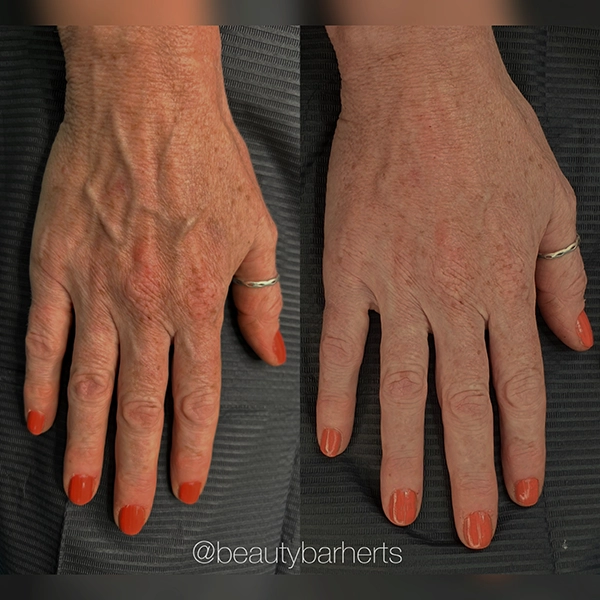 hand treatments antiage hertfordshire